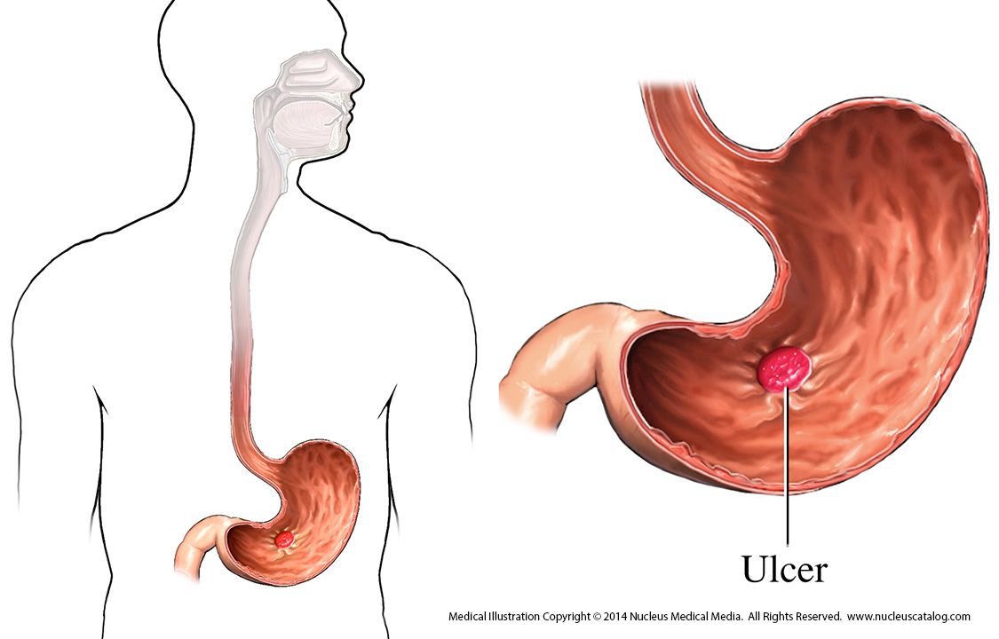 Хүндэрсэн ходоодны шархыг хагалгаагүйгээр эдгээх арга